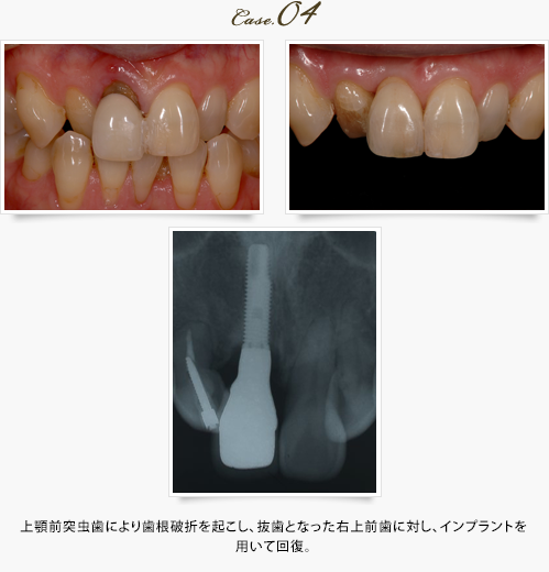 上顎前突虫歯により歯根破折を起こし、抜歯となった右上前歯に対し、インプラントを用いて回復。